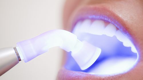 Зачем необходима чистка зубов от камня